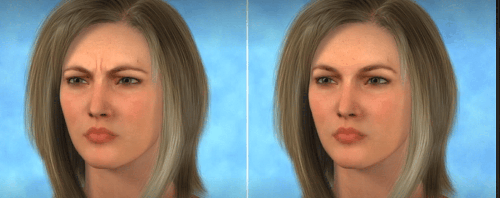 ενεσιμο botox