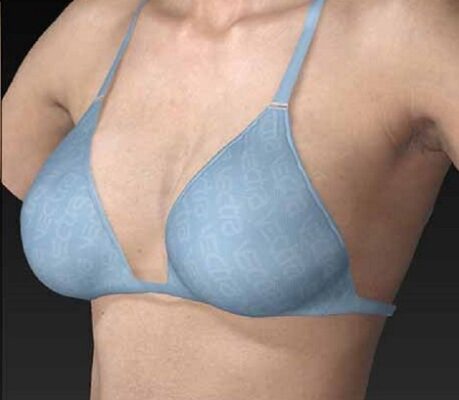 Αυξητική μαστού αυξητικη μαστου