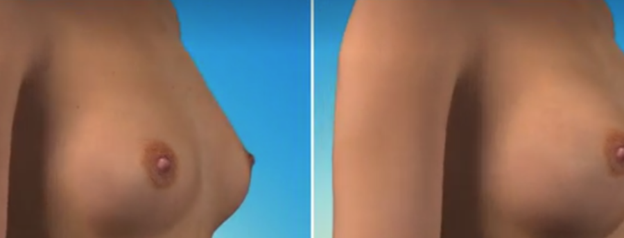 Ανόρθωση στήθους ανορθωση στηθους