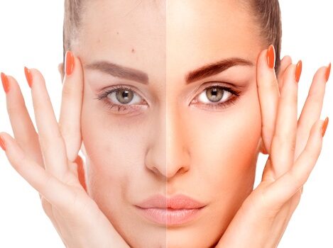 Ανύψωση φρυδιών ανυψωση φρυδιων