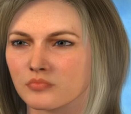 Βοτουλινική εξωτοξίνη Α Βοτουλινική εξωτοξίνη Α