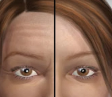 υαλουρονικό οξύ υαλουρονικο οξυ