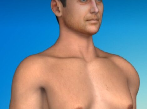 Γυναικομαστία σε άνδρα γυναικομαστια ανδρας