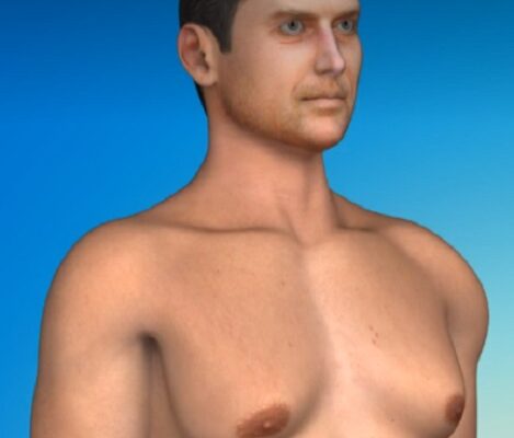 Γυναικομαστία σε άνδρα γυναικομαστια ανδρας