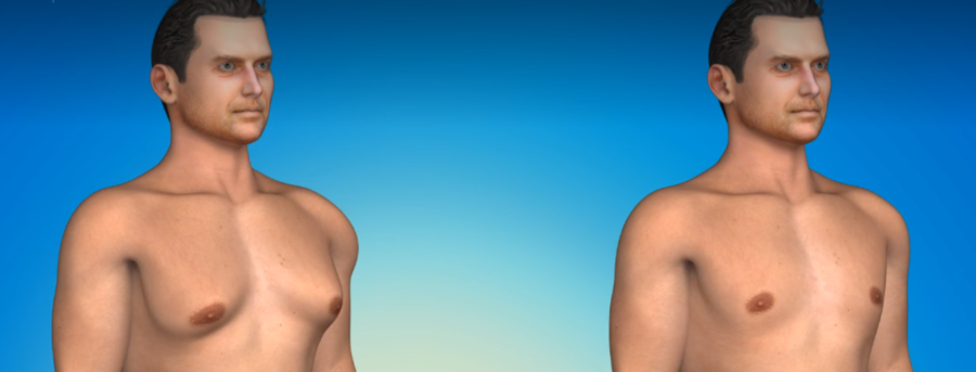 Γυναικομαστία γυναικομαστια