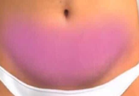 Επέμβαση κοιλιοπλαστικής Επέμβαση κοιλιοπλαστικής σε γυναίκα στην Αθήνα