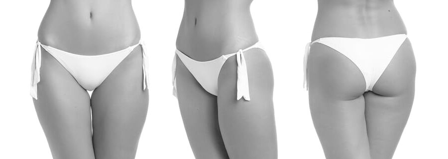 Lifting μηρών λιφτινγ μηρων