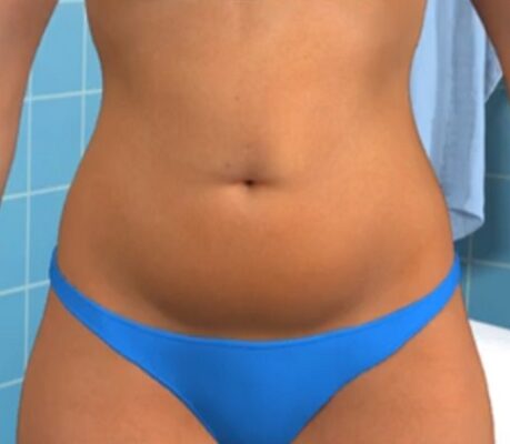 Λιποαναρρόφηση Αθήνα λιποαναρροφηση αθηνα