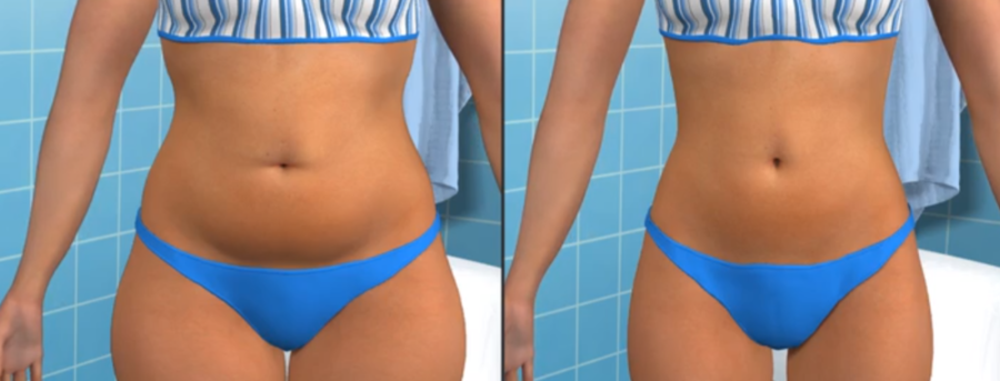 Λιποαναρρόφηση πριν και μετά λιποαναρροφηση πριν μετα