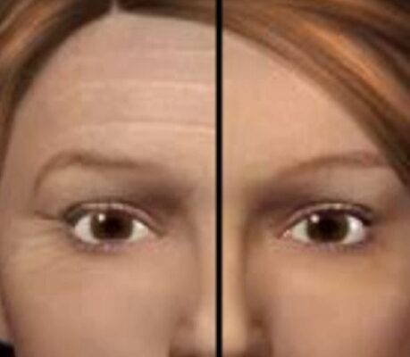 Χημικό πίλινγκ χημικο πιλινγκ