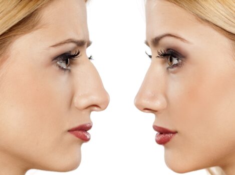 Ρινοπλαστική ρινοπλαστικη