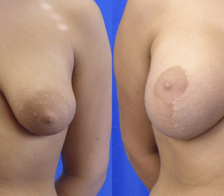 Σωληνωτοί μαστοί σωληνωτοι μαστοι