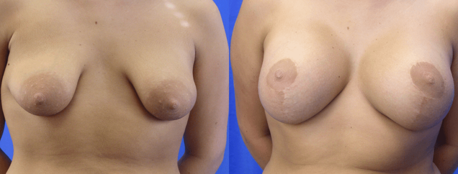 Σωληνωτοί μαστοί σωληνωτοι μαστοι