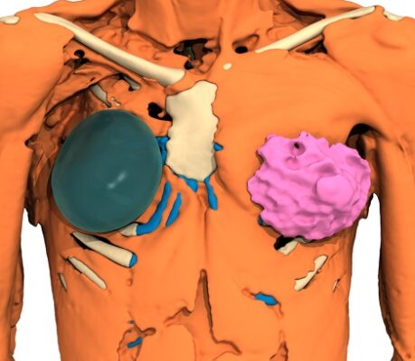 Άνδρας με σύνδρομο poland συνδρομο πολαντ