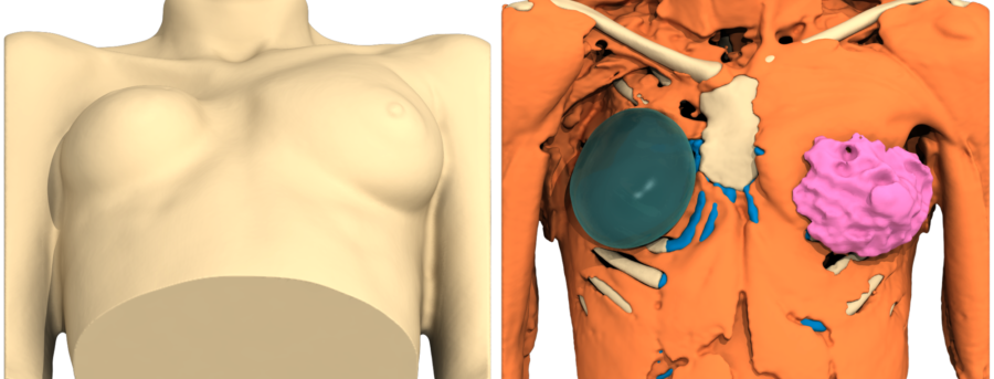 Σύνδρομο poland συνδρομο poland