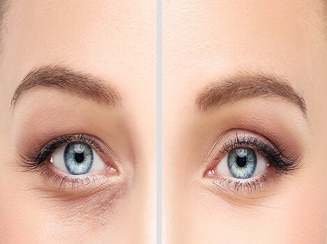 Αποτέλεσμα βλεφαροπλαστικής βλεφαροπλαστικη αποτελεσματα