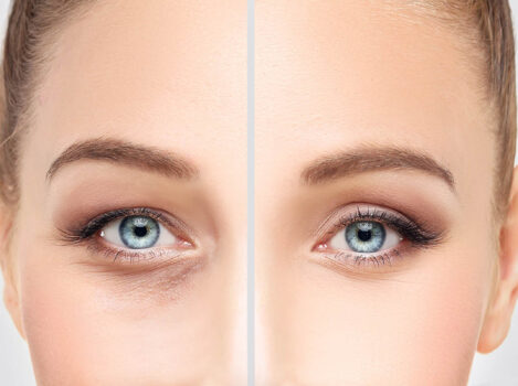 Αποτέλεσμα βλεφαροπλαστικής βλεφαροπλαστικη