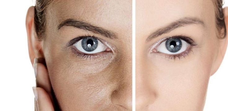 filler υαλουρονικό filler με υαλουρονικο