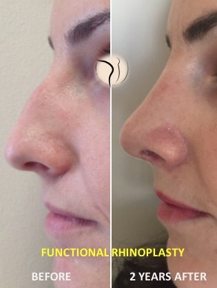 Πριν-Μετά ρινοπλαστική πριν και μετά ρινοπλαστική