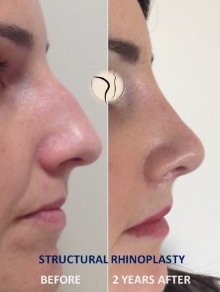 Αθήνα ρινοπλαστική πριν και μετά Αθήνα ρινοπλαστική πριν μετά