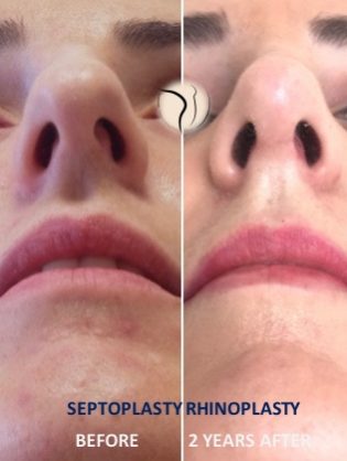 Πλαστική μύτης πριν και μετά Πλαστική μύτης πριν μετά