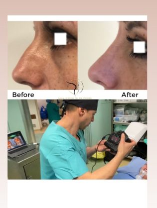 Αθήνα πλαστική μύτης Αθήνα πλαστική μύτης, πριν και μετά