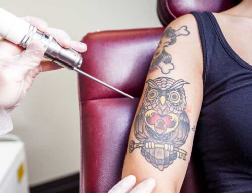 Αφαίρεση τατουάζ