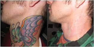 Αφαίρεση τατουάζ από ανδρικό λαιμό