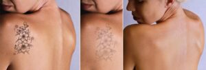 Αφαίρεση τατουάζ πριν και μετά