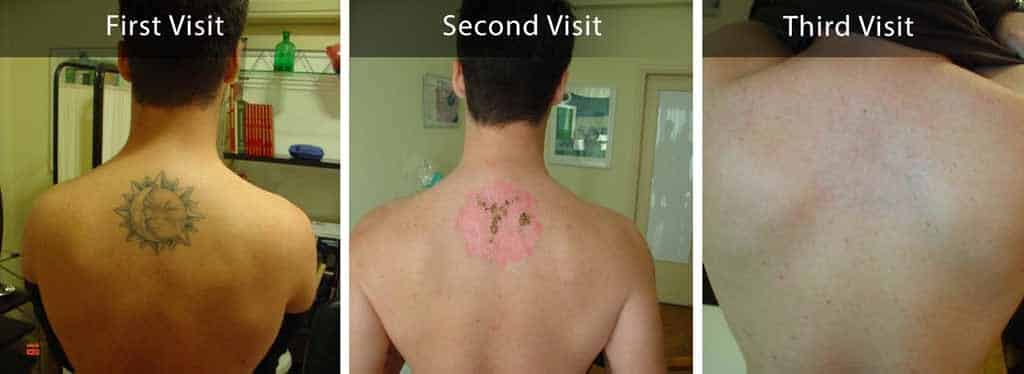 Πριν και μετά την αφαίρεση τατουάζ σε άνδρα