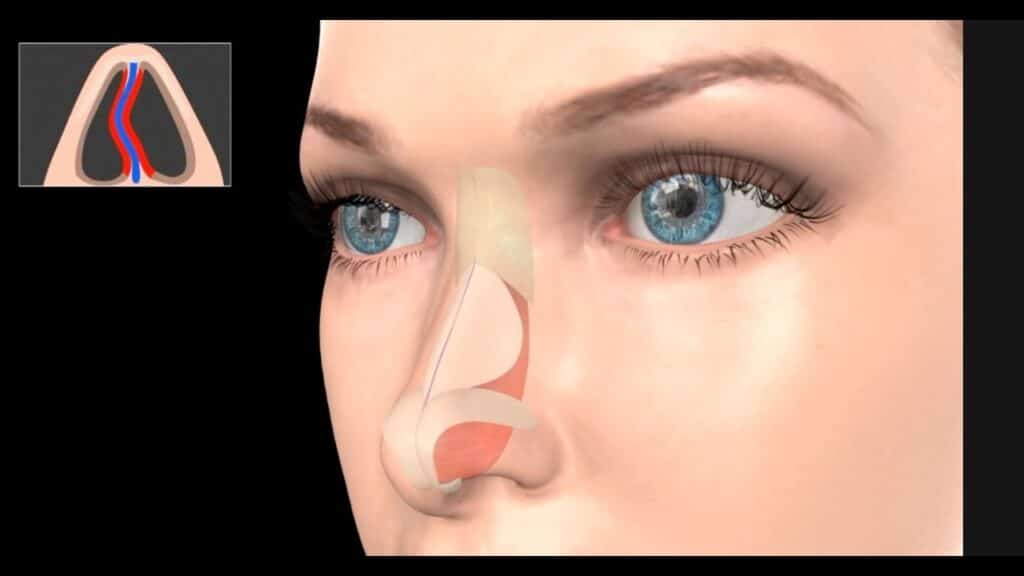 Γυναίκα με στραβό διάφραγμα μύτης
